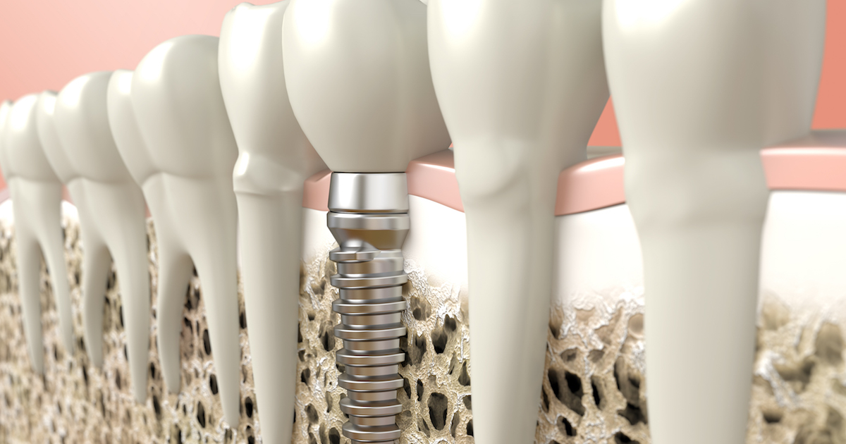 Dental implant